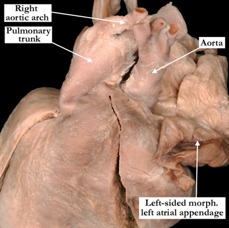 02-06-05-aortic-root-directly-leftward-to-pulmonary-root-side-by-side
