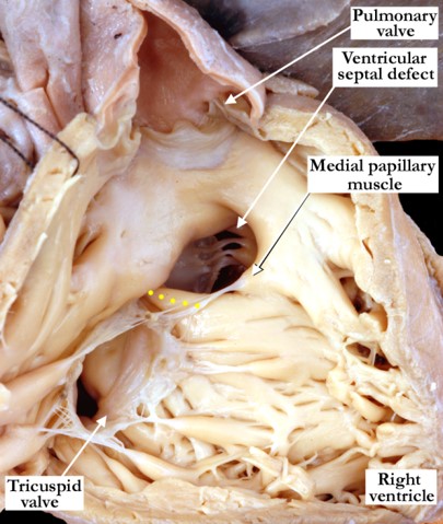 07-11-14 Muscular outlet ventricular septal defect