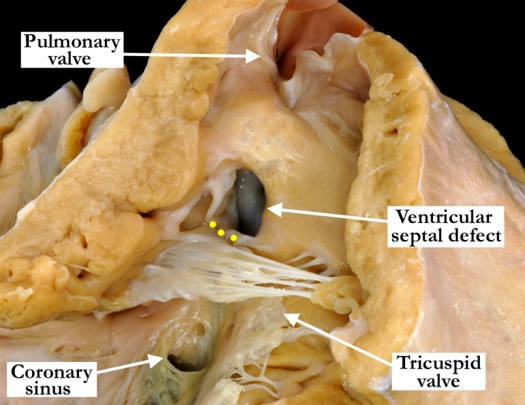 07-12-00 Outlet ventricular septal defect