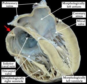 01.04.00 - Concordant atrioventricular connections - ISNPCHD